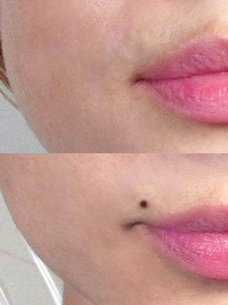 beauty mark/ mole
