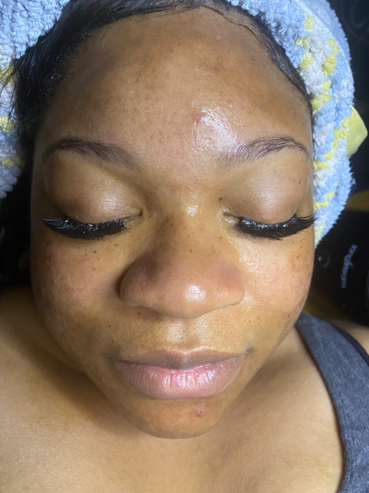 Dermaplane Facial