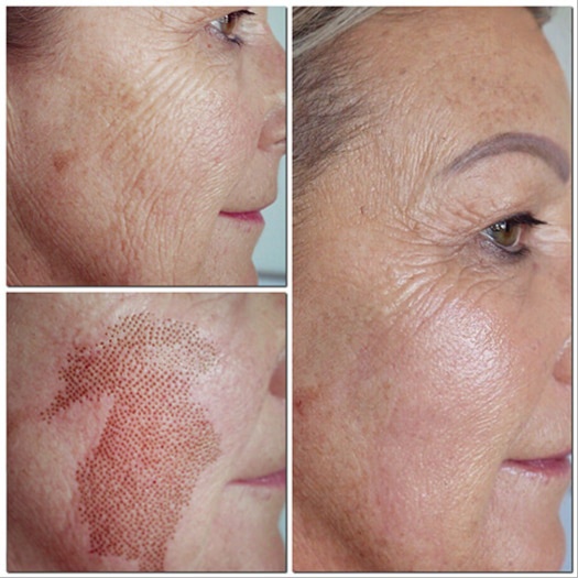 Fibroblast Treatment (Full Face) at Luscious Tox Aesthetics in Arlington, TX