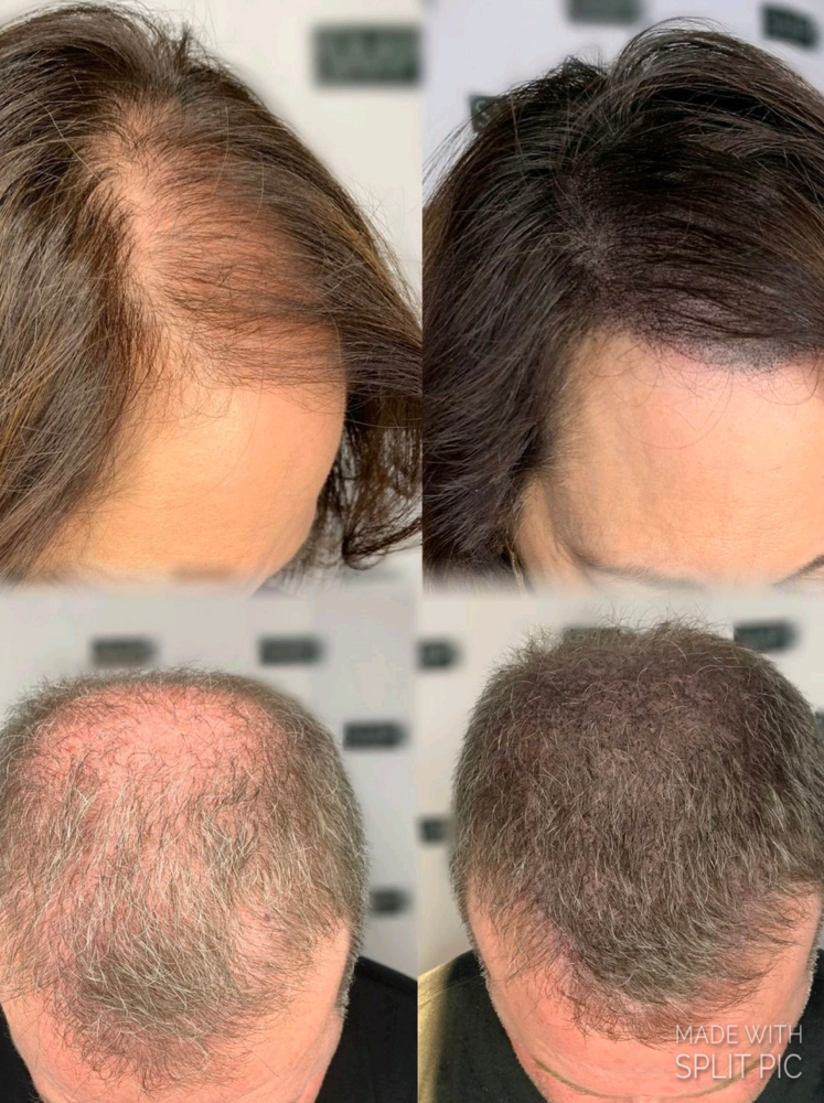 Scalp Micropigmentation
