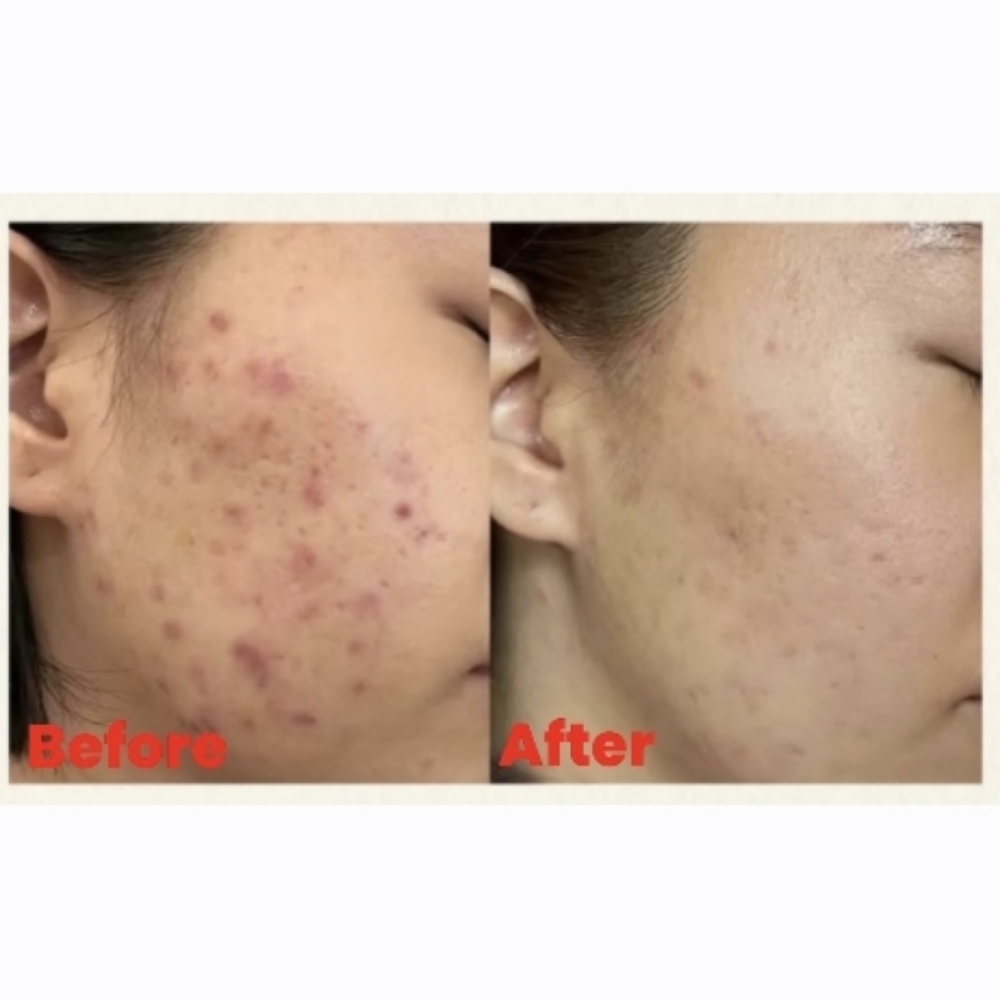 Advanced Acne Peel Facial at Sun Skincare LLC in Scottsdale, AZ