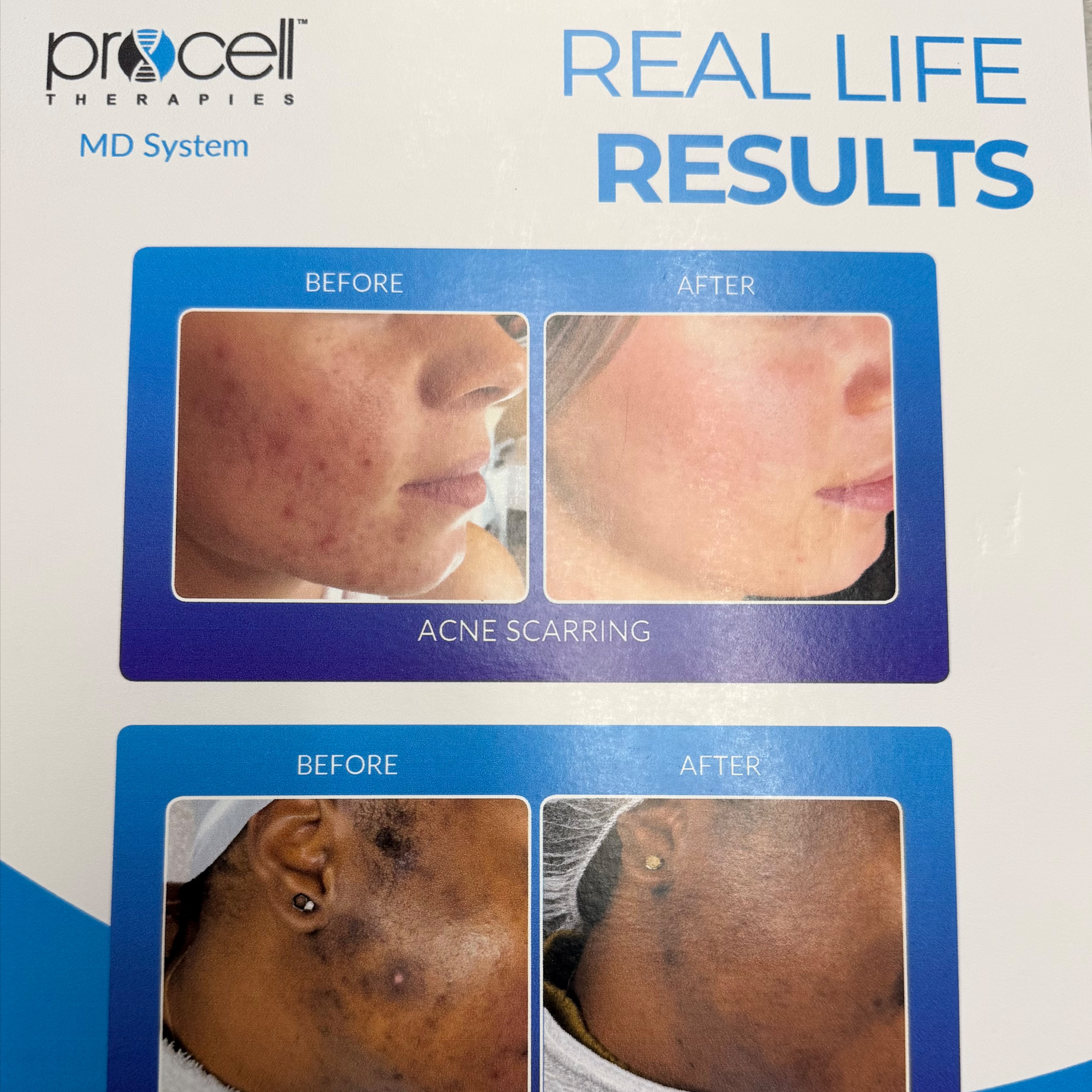 PRO CELL Micro channeling at Revive Skin by Ang in Downey, CA