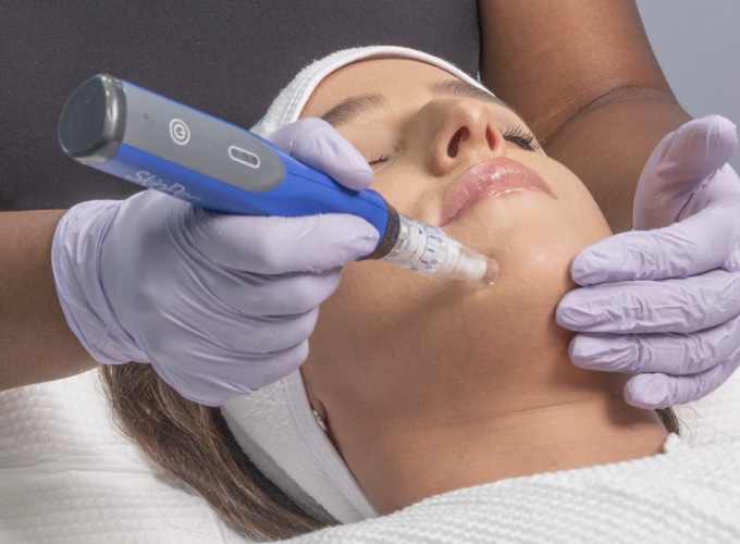 Microneedling treatment (face)