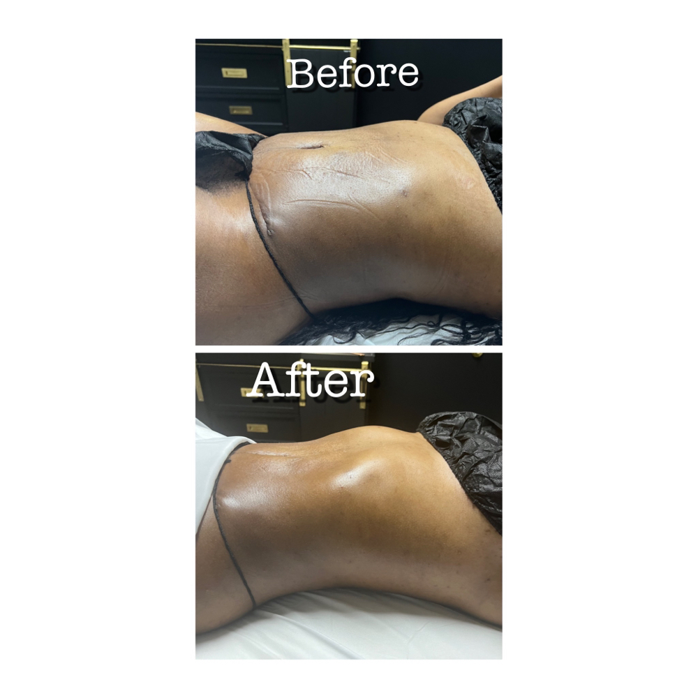 6 Lymphatic Drainage Massage Pack at Wholistic Recovery & Wellness Spa in Snellville, GA
