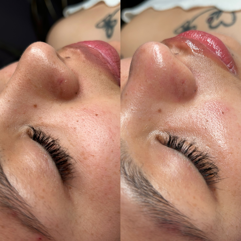 DERMAPLANING  PARA PIEL GRASA