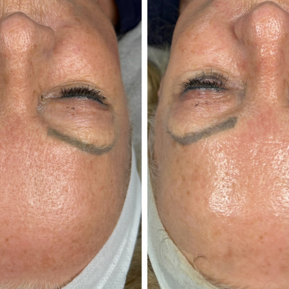 Custom Facials Based On Your Skin at Southern Sparkle Medical Aesthetics in Swainsboro, GA