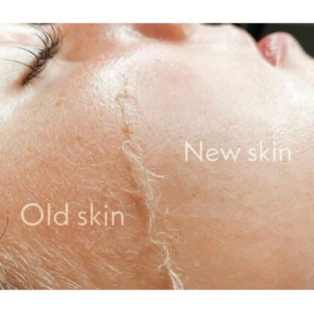 Vi Peel at Skin Ritual Aesthetics by Janine in Chesterfield MO, MO