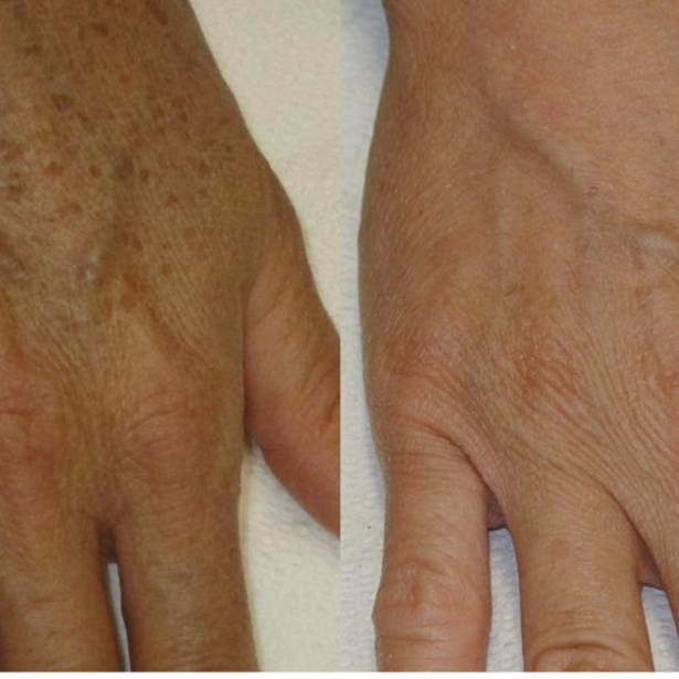 IPL laser hands at The Laser Collective in Gilbert, AZ