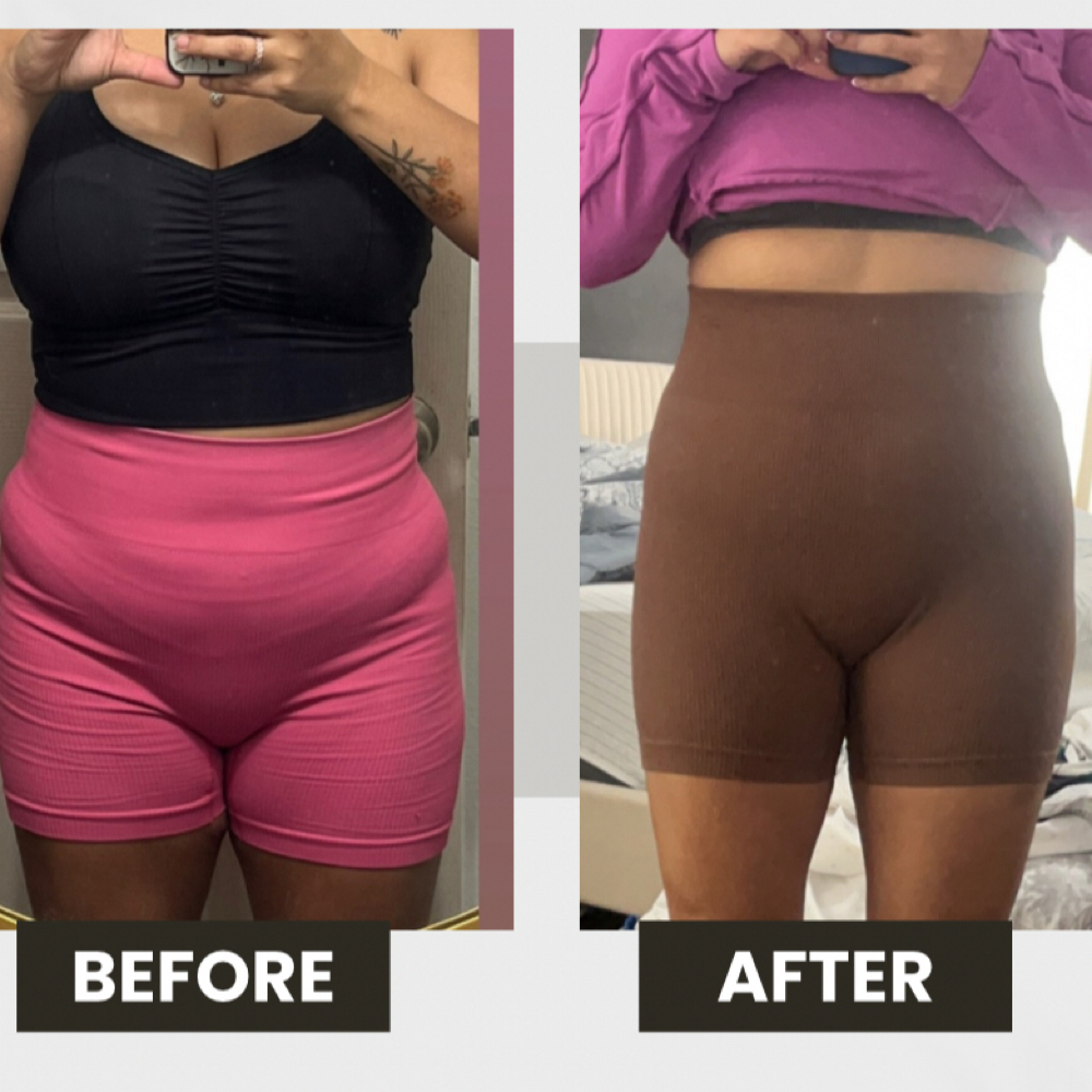 Trizepatide at TRES Aesthetics in Missouri, TX