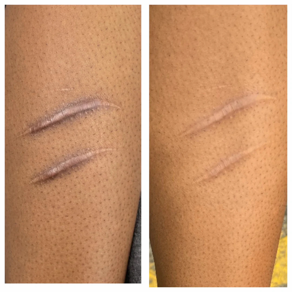 Scar Camouflage at ArteSana by Steph in Altamont, NY
