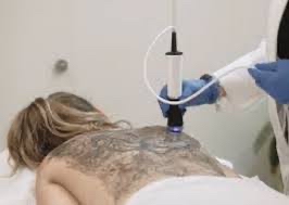 OxygeneO Back Facial