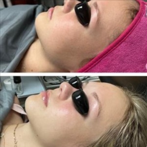 Carboxy CO2 Therapy Facial at Marco Island Aesthetics