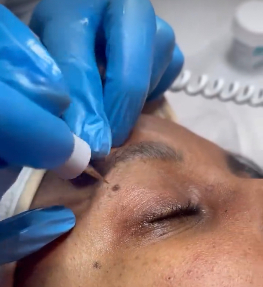 Skin Tag / Mole Removal (upto 5) at Sachi Nails and Body Spa in Yonkers, NY