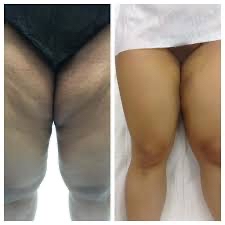 INNER & FRONT THIGH FAT