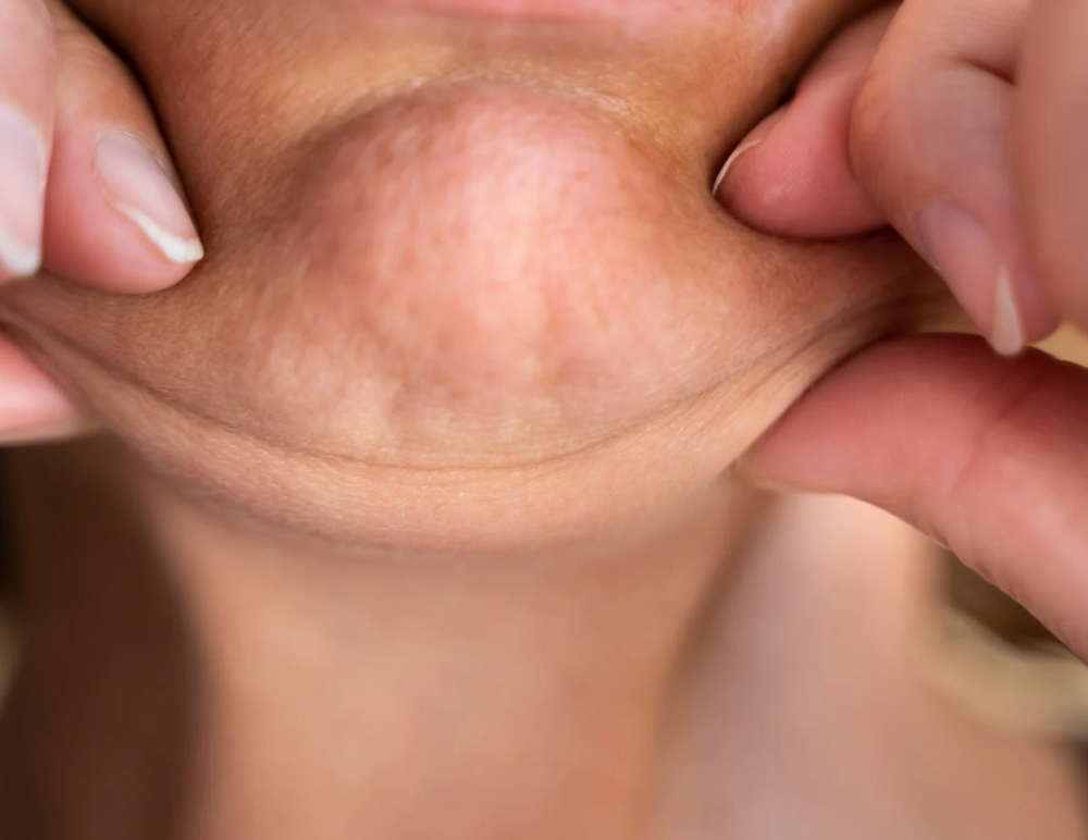 Chin Dimpling