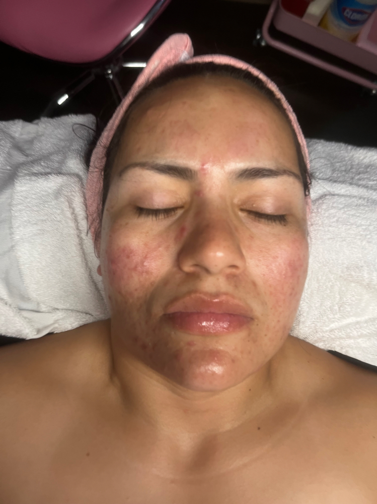 Acne Facial ☁️🎀