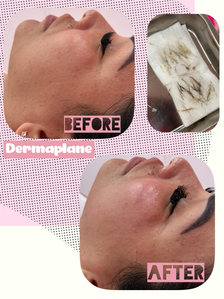 Dermaplane