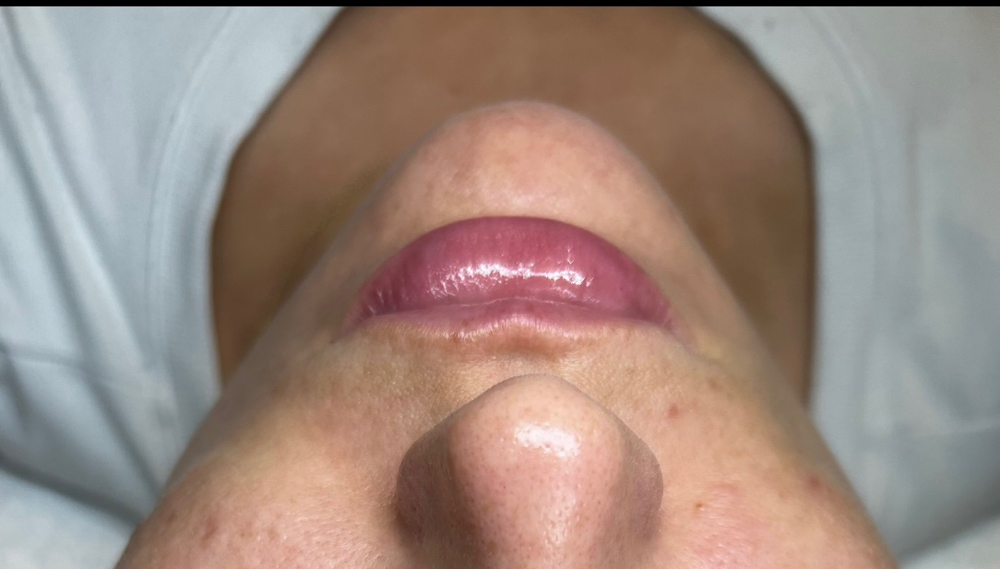 Lip Treatment at Jisell Aesthetics in Houston, TX