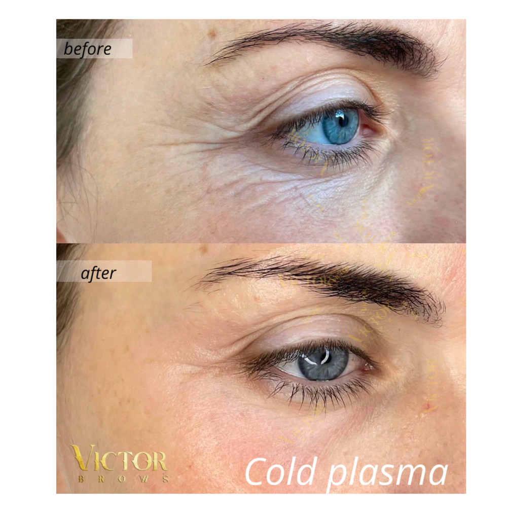 COLD PLASMA FULL FACE