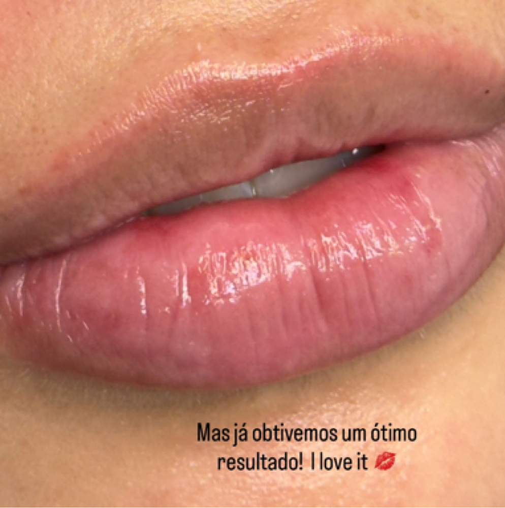 Hydro lips at sofia dias in gloucester, MA