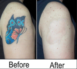 Tattoo Removal