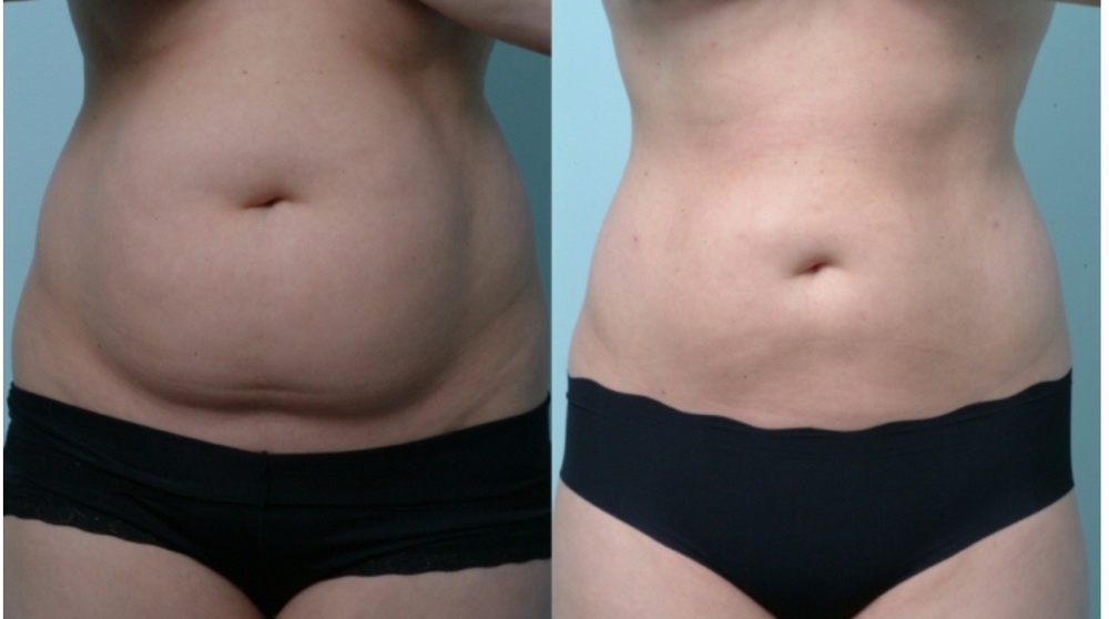 (6) Express Body Contouring Package