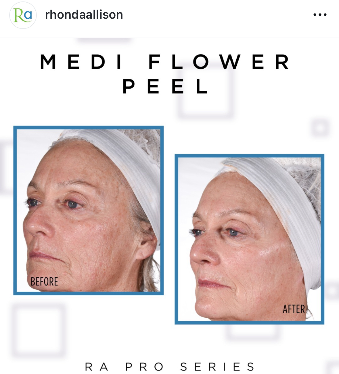 MEDI FLOWER PEEL with Post Care