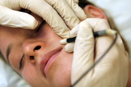 Electrolysis 60 minutes