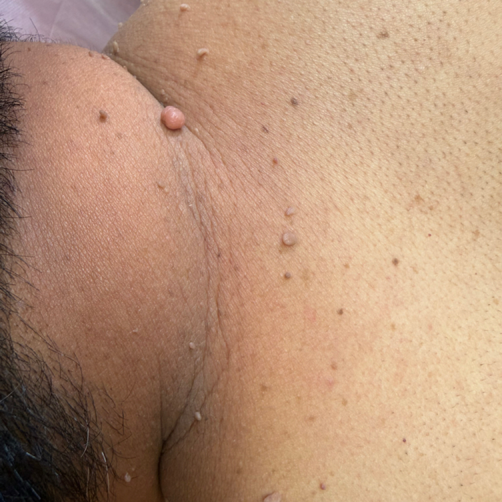 Sking Tag Laser Remove at 🎀Pink Diamond Beauty studio🎀 in Irving, TX
