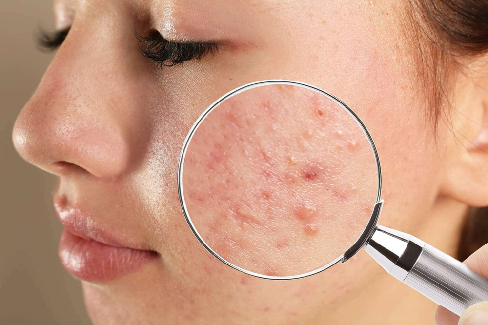 Acne B.C Facial(Established Client)