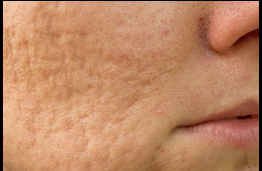 Acne Scar Revision