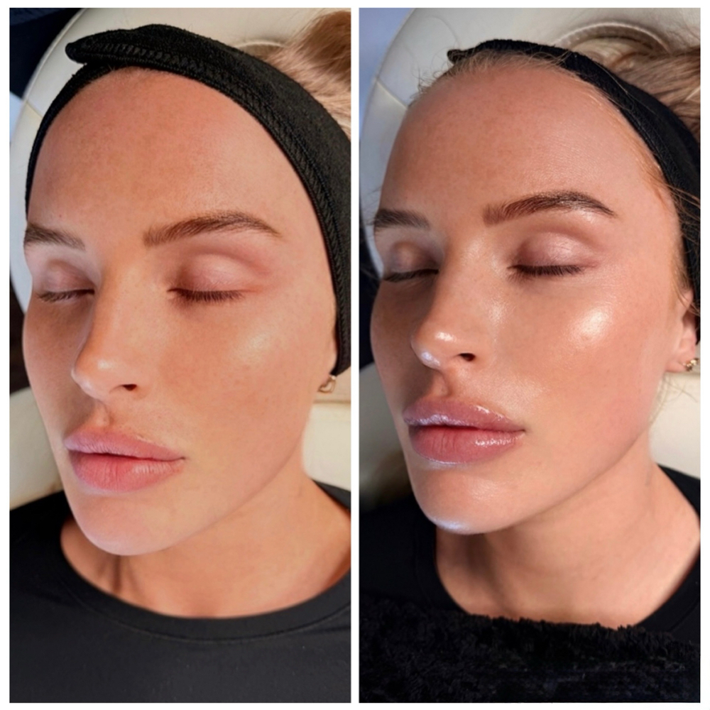 Regenerative Glo 2 Facial at Rise iV & Beauty Bar in New Braunfels, TX