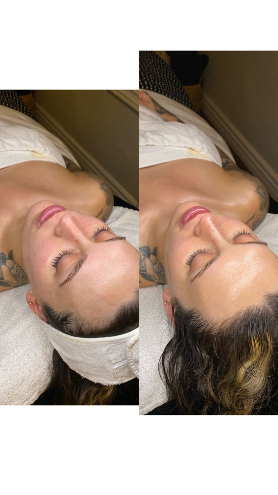 Hydrofacial Treatment