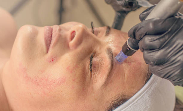 Microneedling [Collagen Induction]