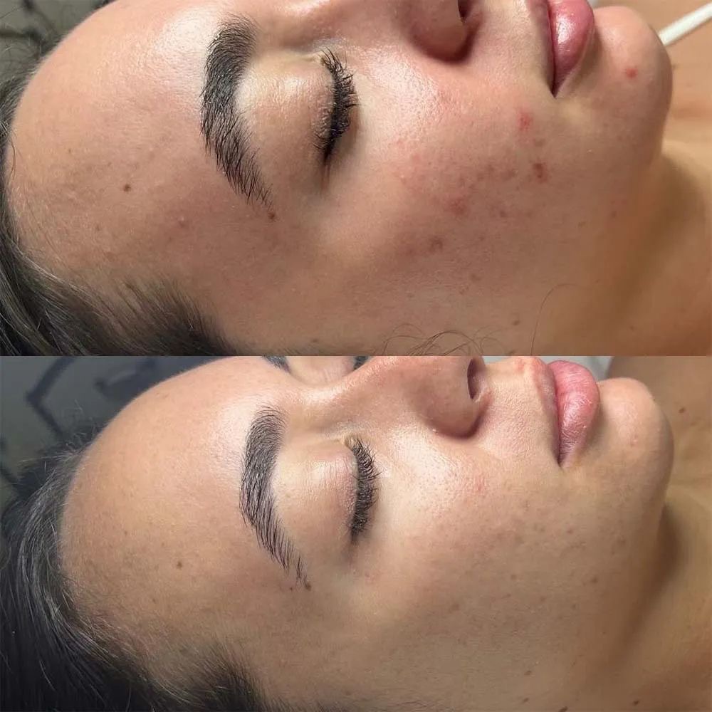 Chemical Peel ☁️ at Glow By Clau in Chicago, IL