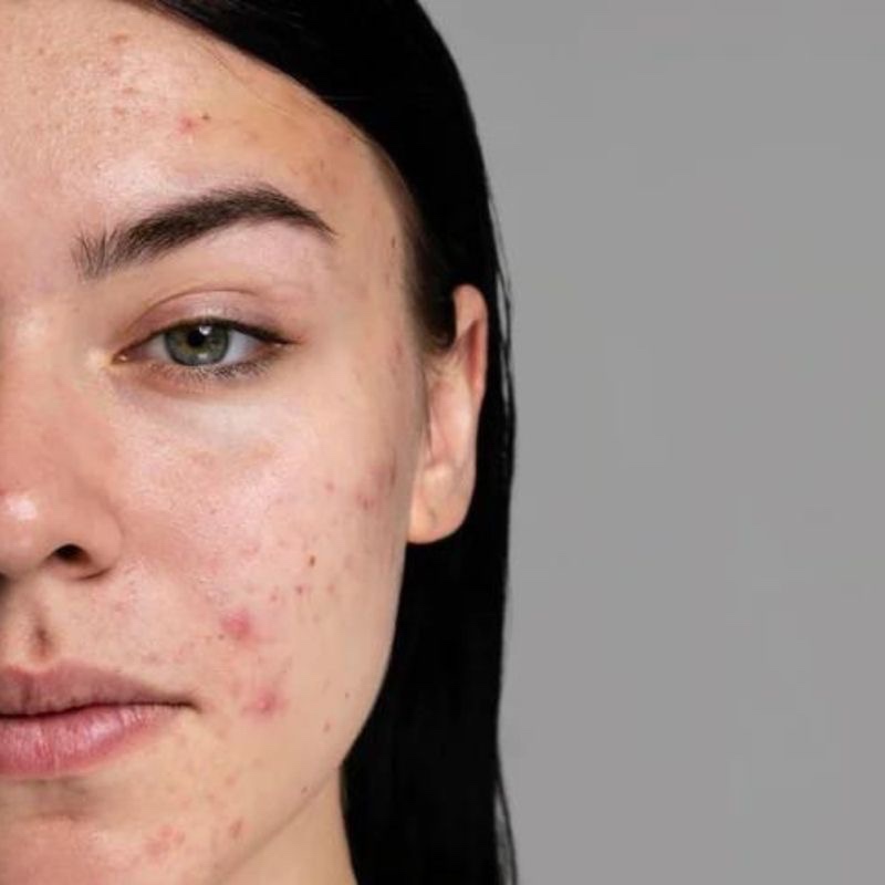 Acne-Care Teen Facial at Shelby Langston in Brock, TX