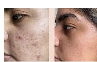 Clinical Acne Facial