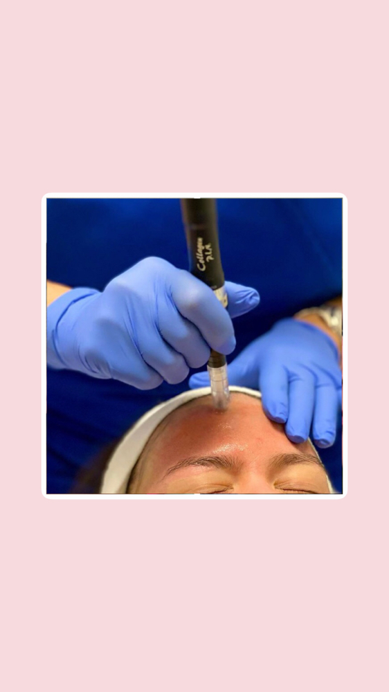 Microneedling