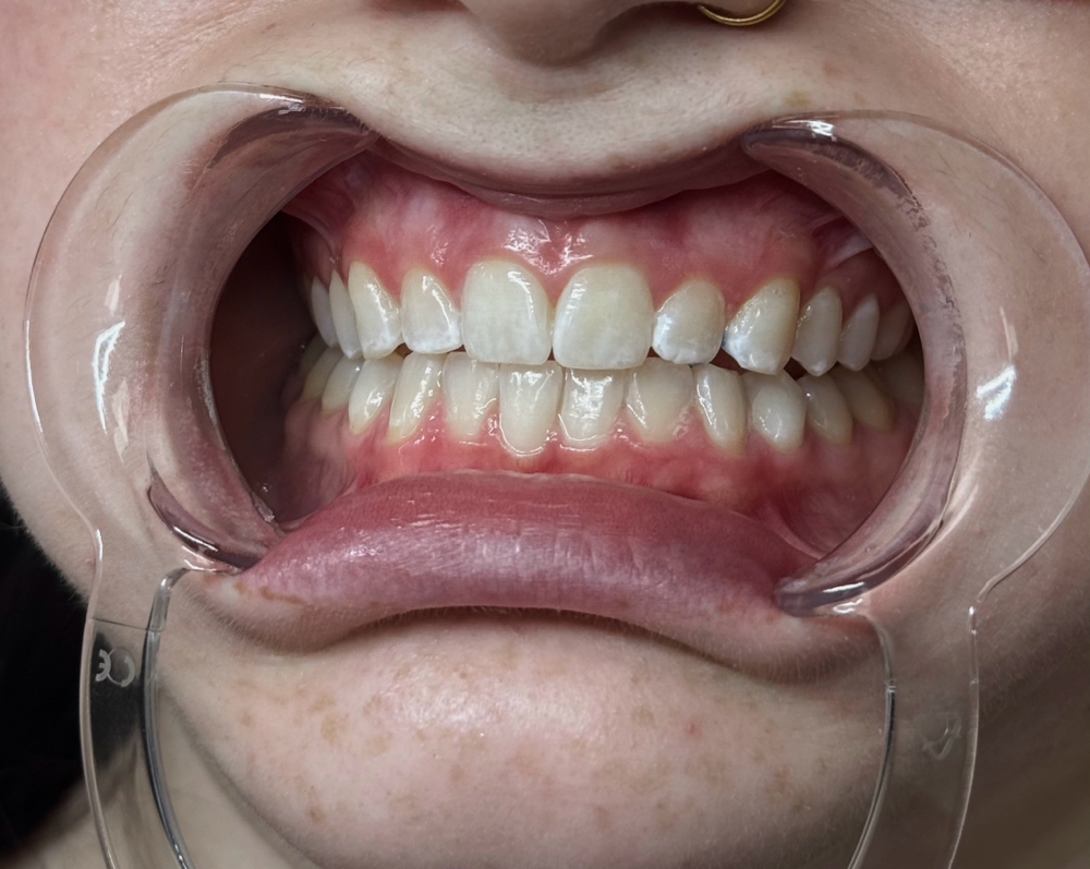 60 Min Teeth Whitening Top Up