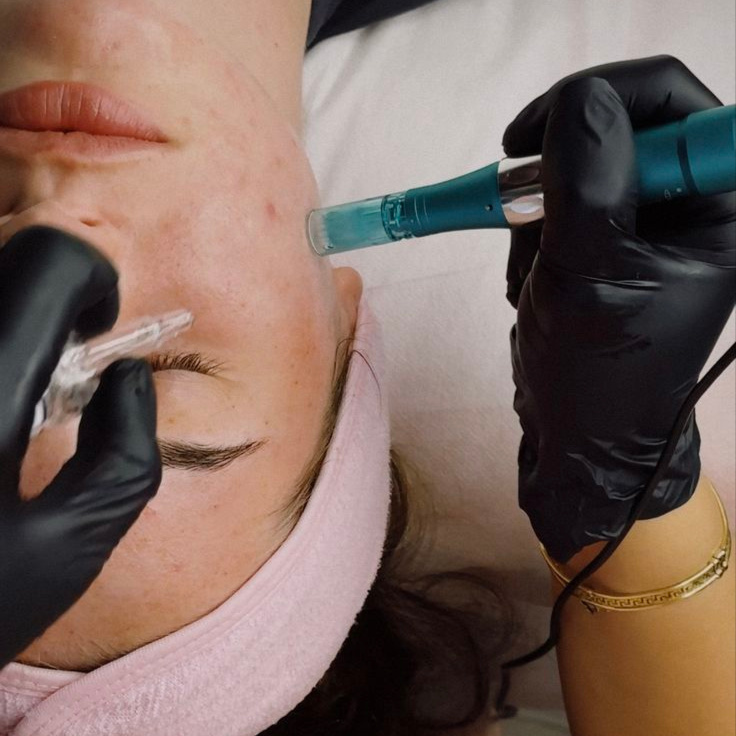 Microneedling at Lily Ruth Esthetics in New Berlin, WI
