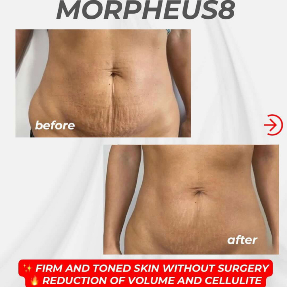 Morpheus8 Body at Blissful Electrolysis Studio in Las Vegas, NV