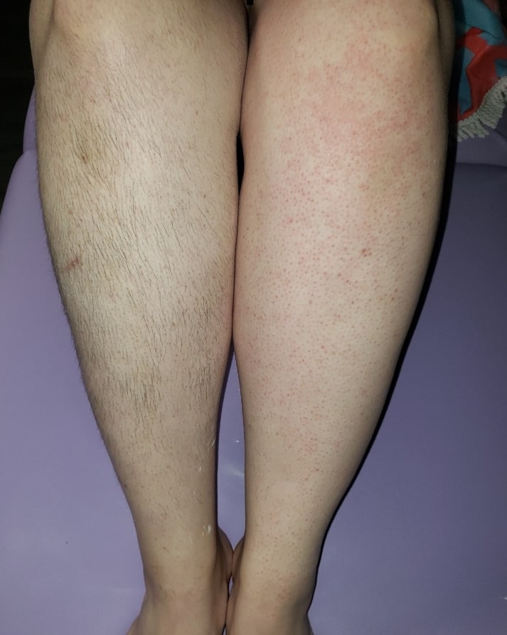 Half Legs Sugaring