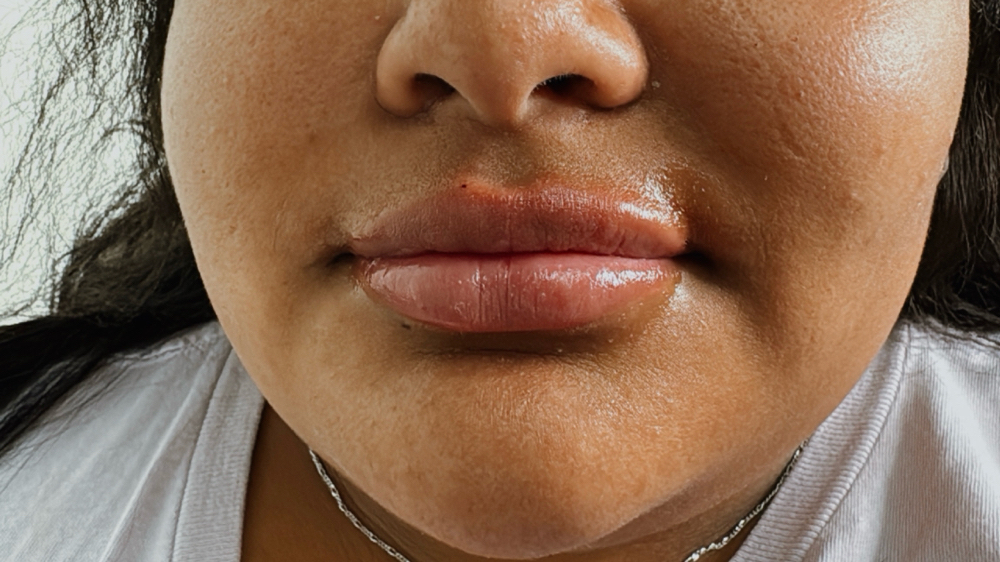 Lip Enhancement (Filler)