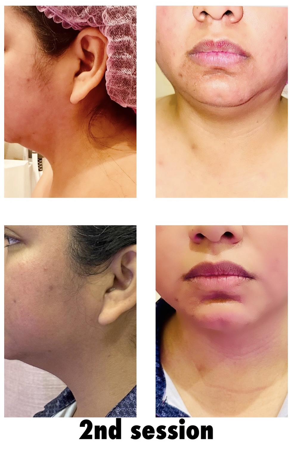 Chin reduction -Radio Frequency