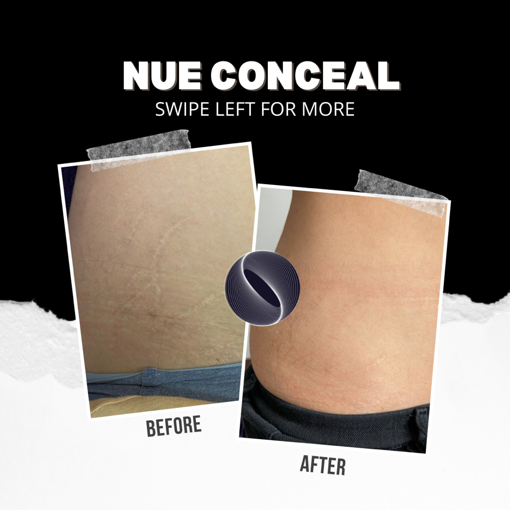 Inkless/Camo Stretchmarks Both Hips