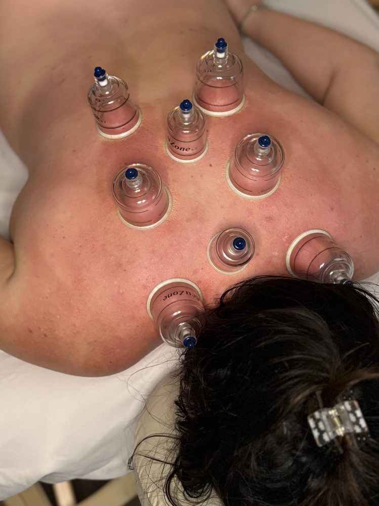 Cupping