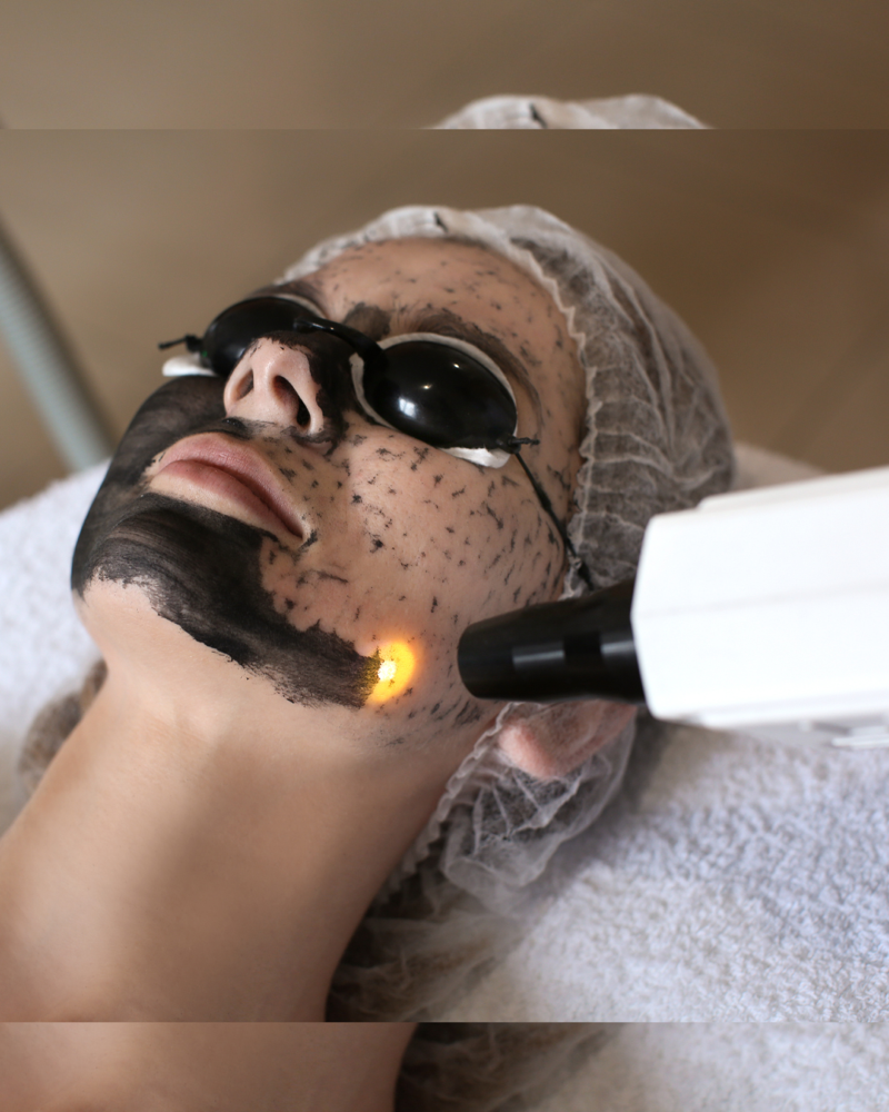 Carbon Laser Facial