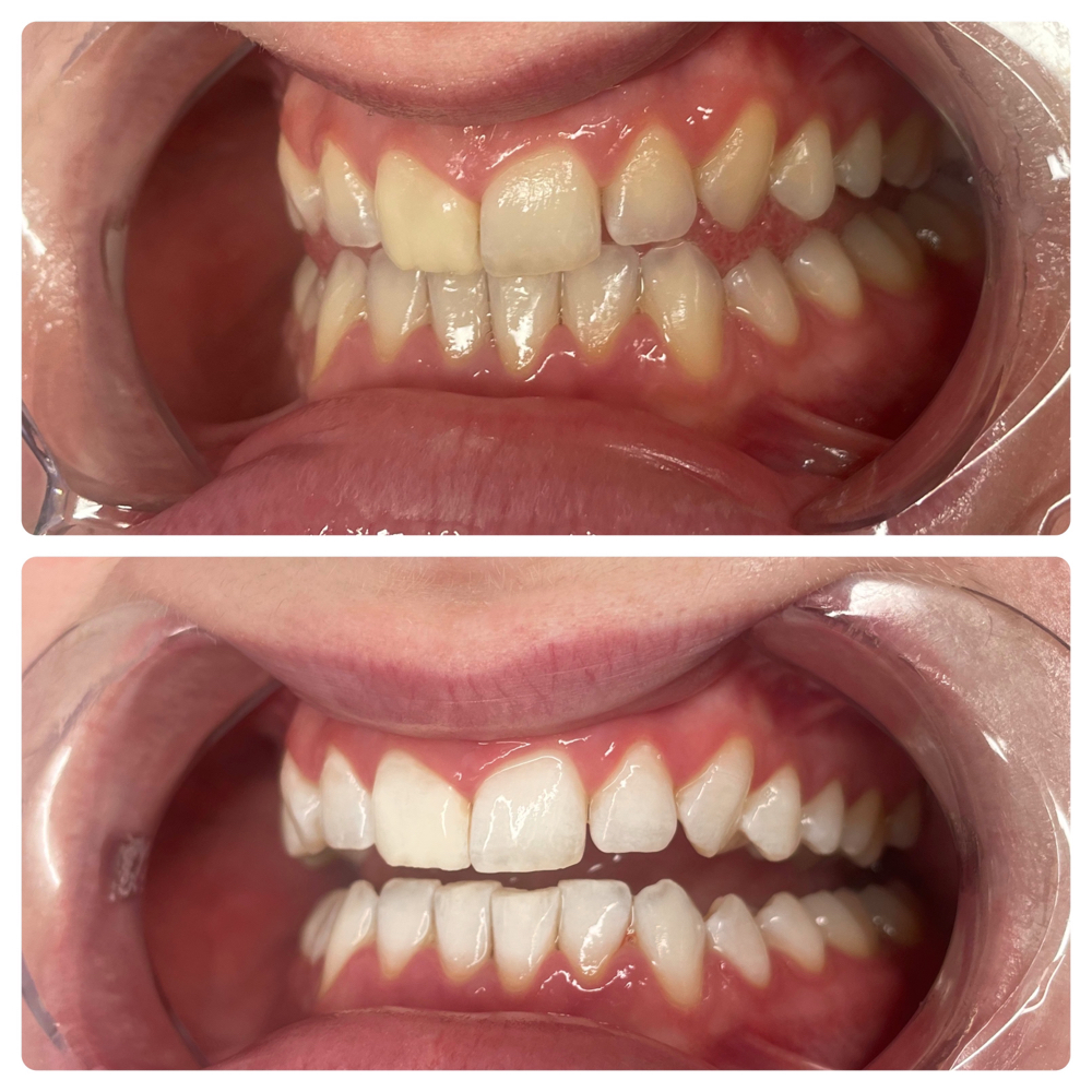 Teeth Whitening