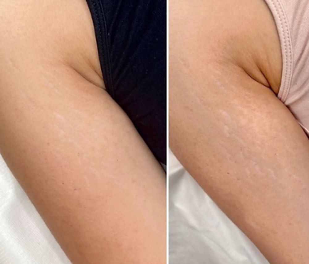 Scar And Stretch Mark Revision