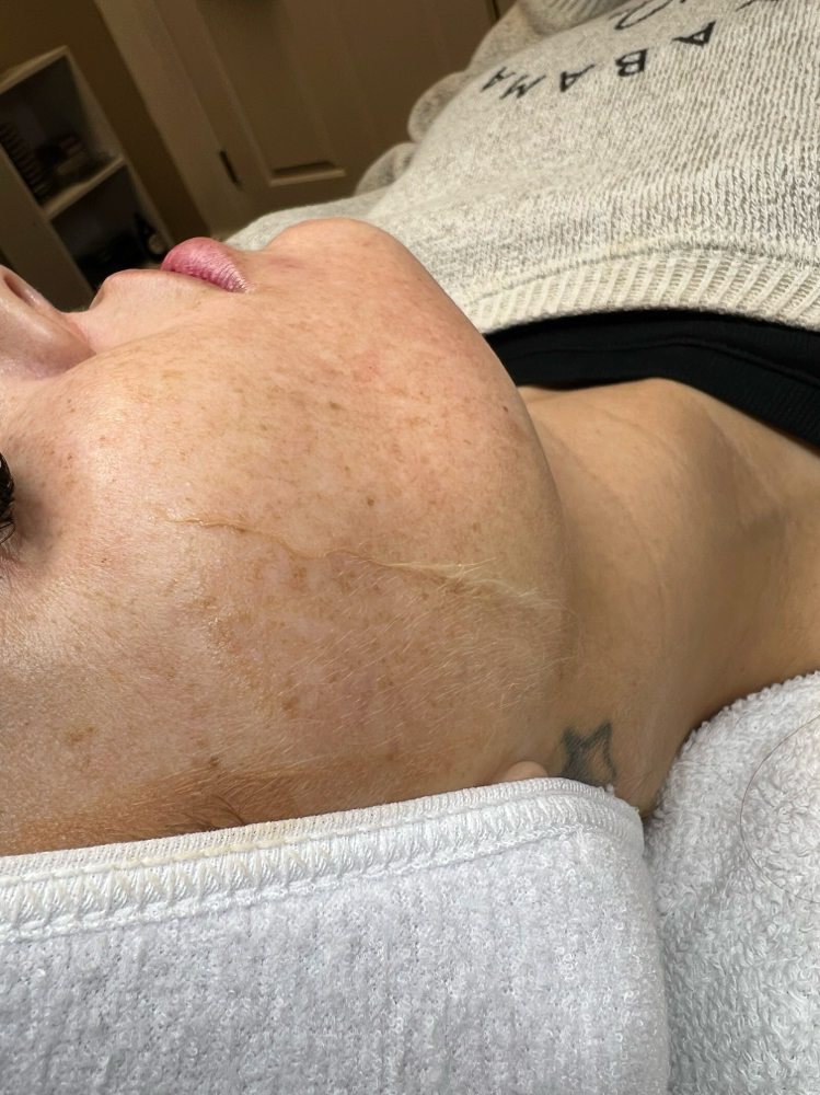 Dermaplane Add-On